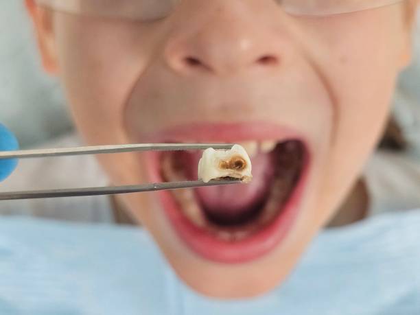 Best Broken or Chipped Tooth Repair in Kurtistown, HI